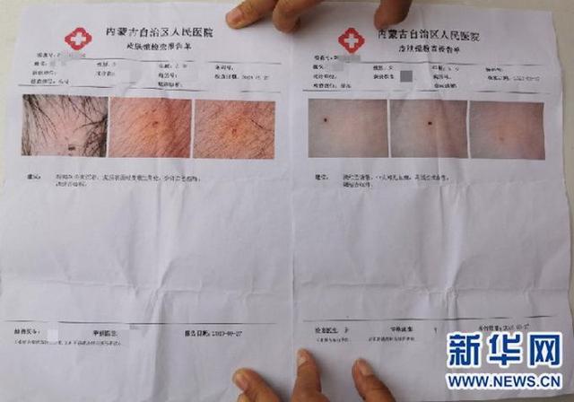 幼儿园孩子身上现针眼 警方通报具体说了什么？到底发生了什么？