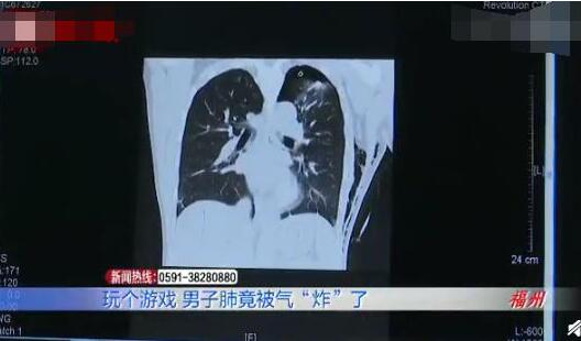 怒气冲天！男子打游戏4小时连输肺气炸 原来肺真的会气炸