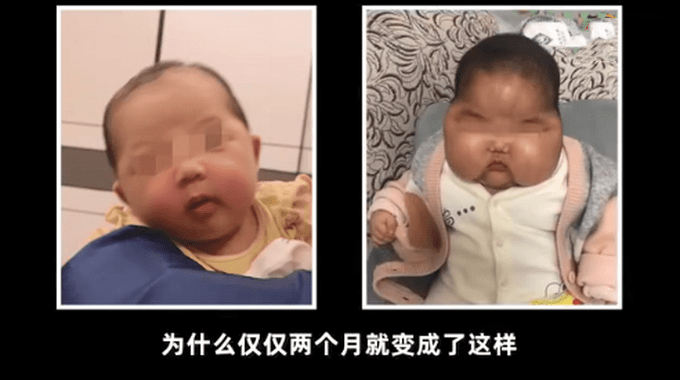 5个月婴儿成“大头娃娃”!厂家不认可家属送检结果
