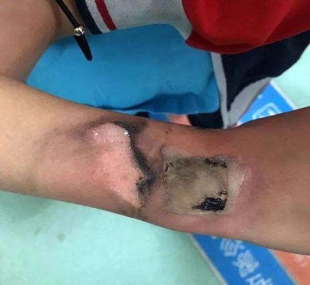 后怕!电话手表自燃,泉州一4岁女童手背被烧伤