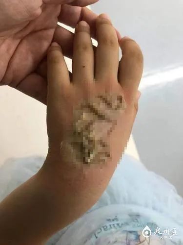 后怕!电话手表自燃,泉州一4岁女童手背被烧伤
